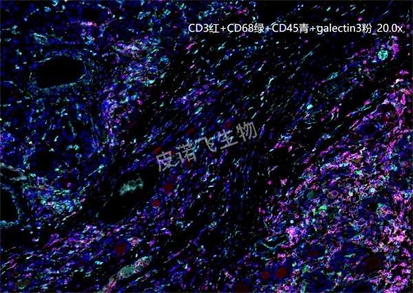 CD3红+CD68绿+CD45青+galectin3粉 肿瘤