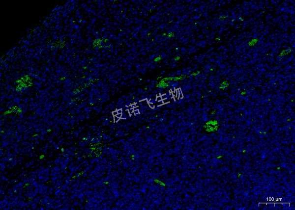 CD4绿 肿瘤