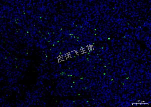 CD8绿 肿瘤