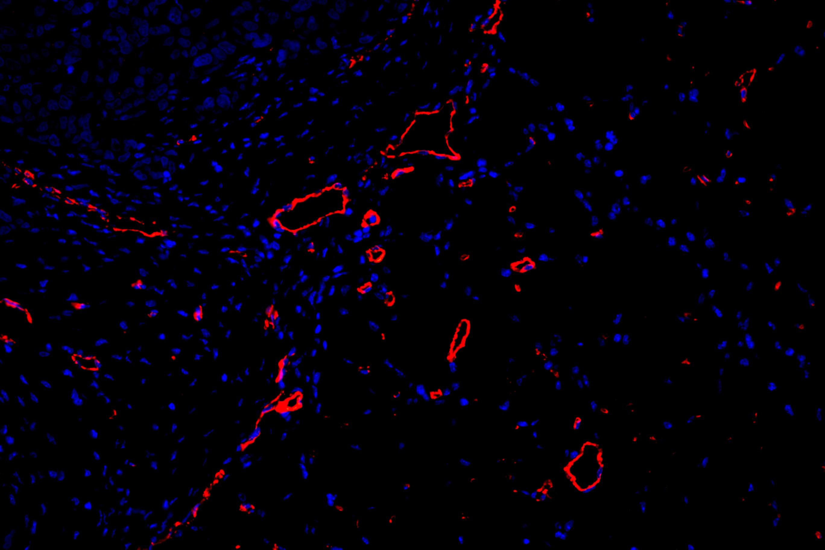 11肿瘤-200-3 cd31+dapi.jpg